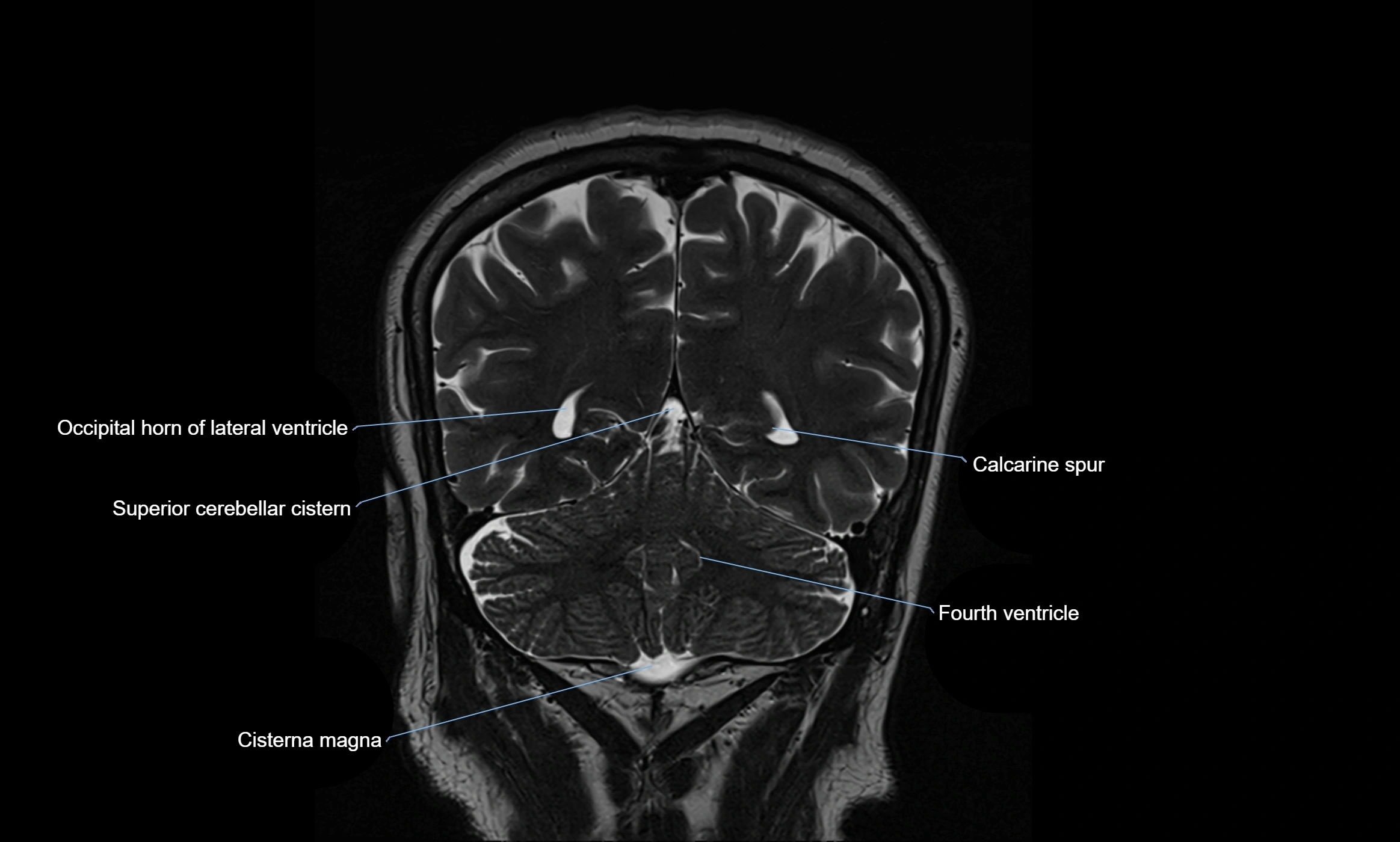 Brain cisterns  and ventricles coronal anatomy 3T MRI image-img-00001-00045.webp